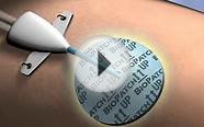 BIOPATCH_Inservice_v3.wmv